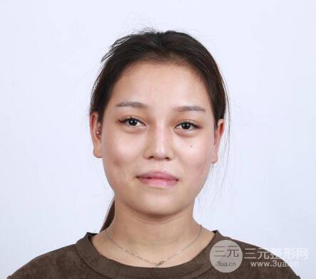 【下颌角+颧骨+下巴】全脸磨骨整形