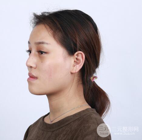 【下颌角+颧骨+下巴】全脸磨骨整形