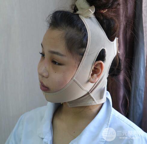 【下颌角+颧骨+下巴】全脸磨骨整形