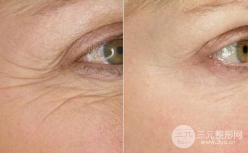缓解鱼尾纹的方法有哪些、去除鱼尾纹要花多少钱