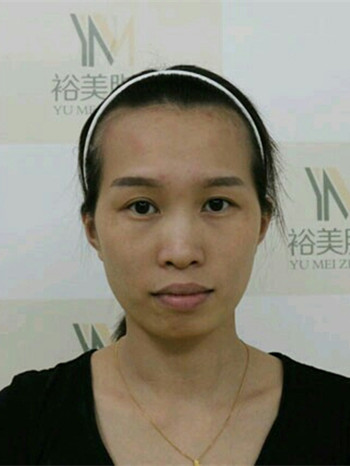 韦文峰全脸脂肪填充日记分享，前后图片对比