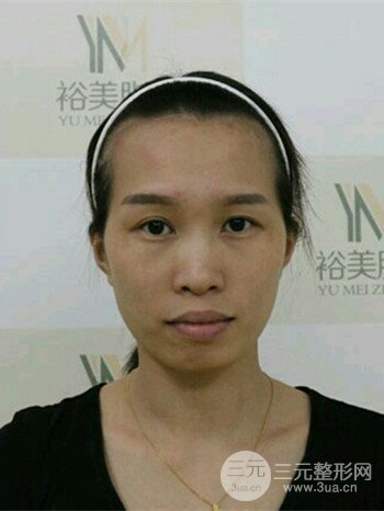 韦文峰全脸脂肪填充日记分享,前后图片对比