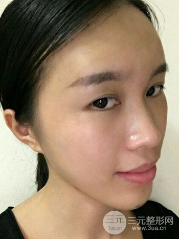 韦文峰全脸脂肪填充日记分享,前后图片对比