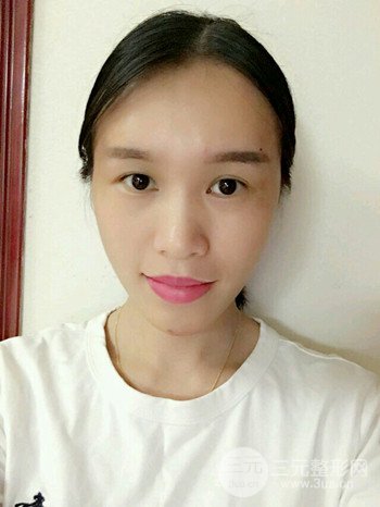 韦文峰全脸脂肪填充日记分享,前后图片对比