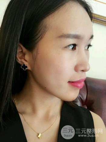 韦文峰全脸脂肪填充日记分享,前后图片对比