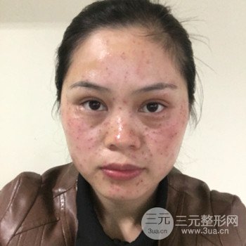 广州激光祛雀斑果不反弹、恢复过程图片分享