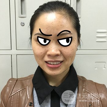 广州激光祛雀斑果不反弹、恢复过程图片分享