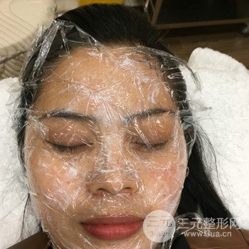 广州激光祛雀斑果不反弹、恢复过程图片分享
