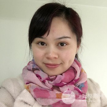 广州激光祛雀斑果不反弹、恢复过程图片分享