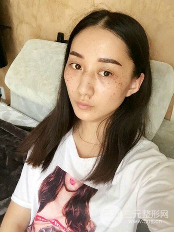 朱彤玥激光祛斑案例、两个月果对比超明X