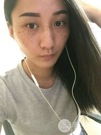 朱彤玥激光祛斑案例、两个月果对比超明X