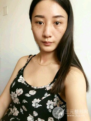 朱彤玥激光祛斑案例、两个月果对比超明X