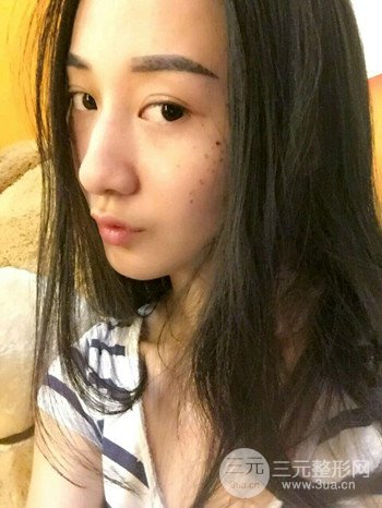 朱彤玥激光祛斑案例、两个月果对比超明X