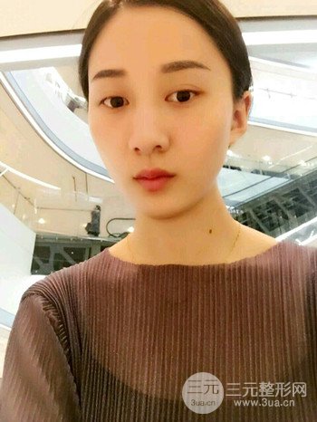 朱彤玥激光祛斑案例、两个月果对比超明X