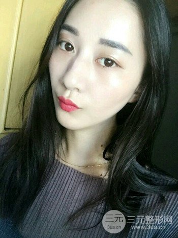 朱彤玥激光祛斑案例、两个月果对比超明X