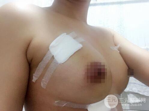 自体脂肪纳米丰胸三个月术后果展示(附图)