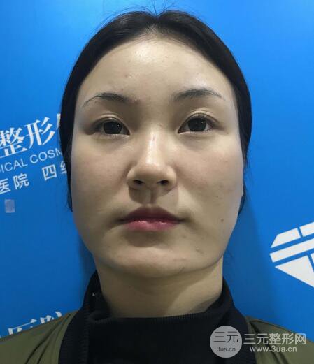 下颌角磨骨整形全过程分享,附上术后恢复照片~