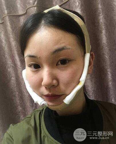 下颌角磨骨整形全过程分享,附上术后恢复照片~
