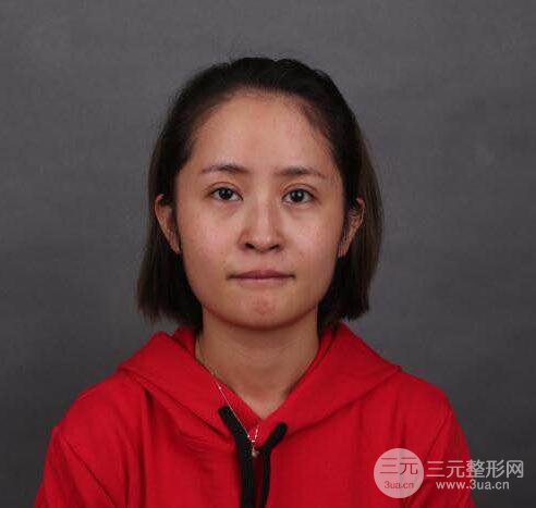 硅胶隆鼻术前术后对比照片分享，走上颜值顶峰