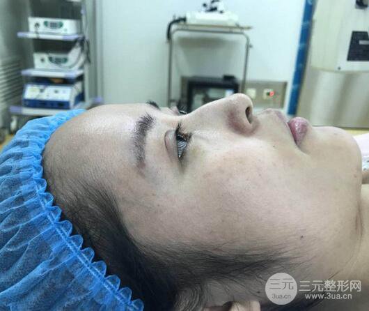 硅胶隆鼻术前术后对比照片分享，走上颜值顶峰