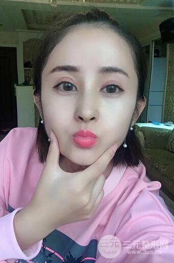 硅胶隆鼻术前术后对比照片分享，走上颜值顶峰