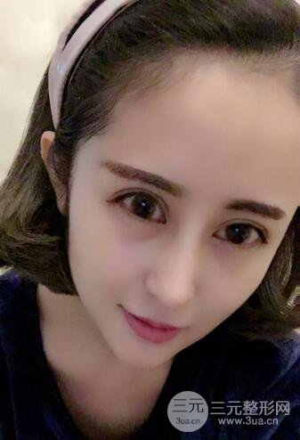 硅胶隆鼻术前术后对比照片分享，走上颜值顶峰