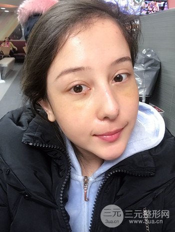广州内切去眼袋术后恢复过程案例对比分享