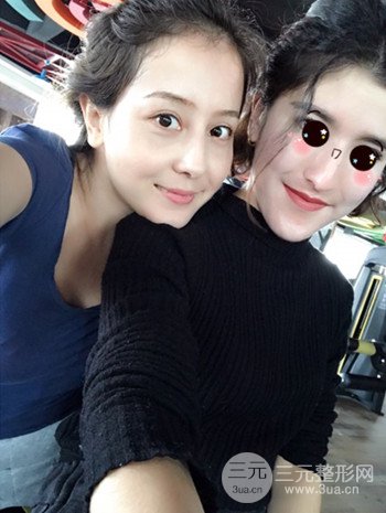 广州内切去眼袋术后恢复过程案例对比分享