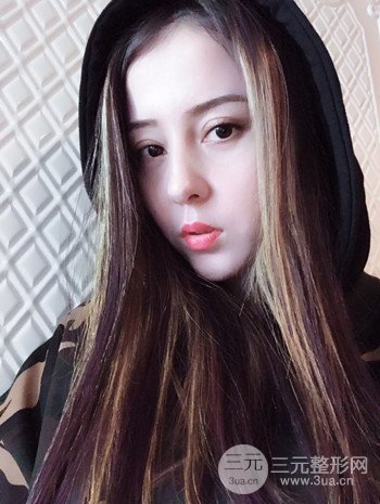 广州内切去眼袋术后恢复过程案例对比分享