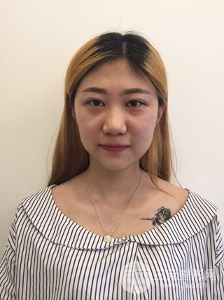 深圳臻希美详细部自体脂肪填充果对比超明X