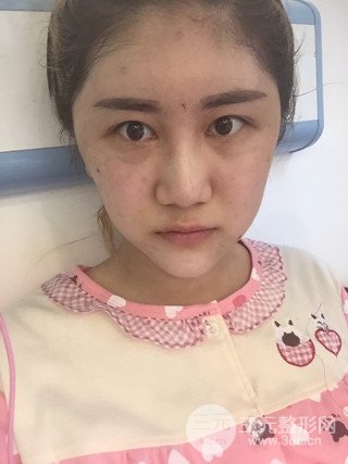 深圳臻希美详细部自体脂肪填充果对比超明X