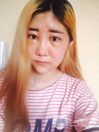 深圳臻希美详细部自体脂肪填充果对比超明X