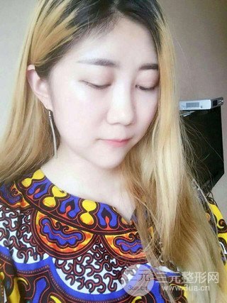 深圳臻希美详细部自体脂肪填充果对比超明X