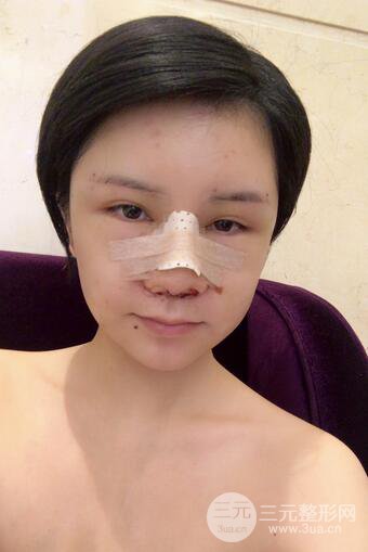做了隆鼻整形隆鼻之后，短发女孩也可以性感！