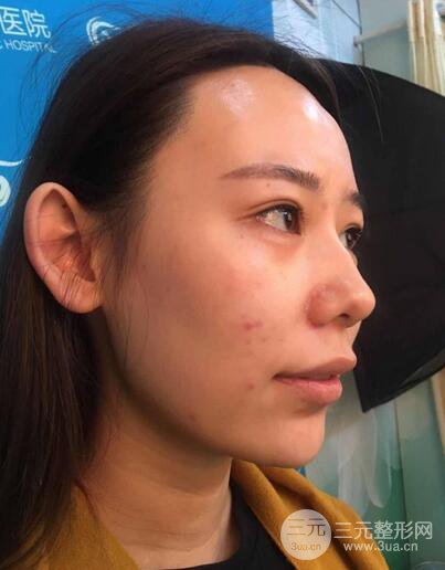 全脸自体脂肪填充,填充不饱满还可以瘦脸_真人案例