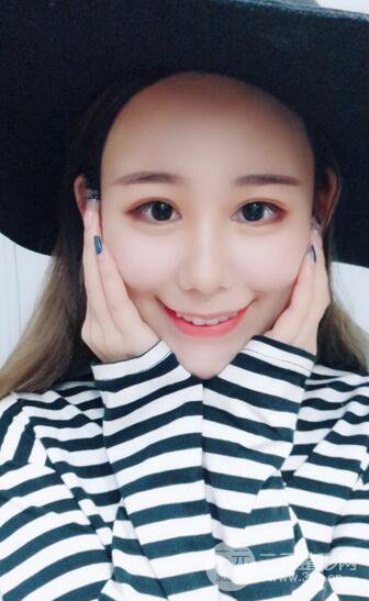 全脸自体脂肪填充,填充不饱满还可以瘦脸_真人案例