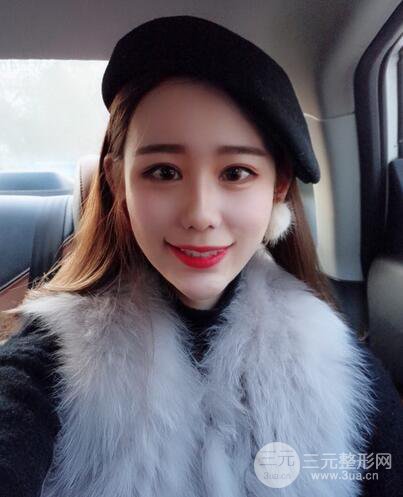 全脸自体脂肪填充,填充不饱满还可以瘦脸_真人案例