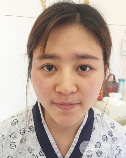 膨体隆鼻术后恢复果图_全过程解密