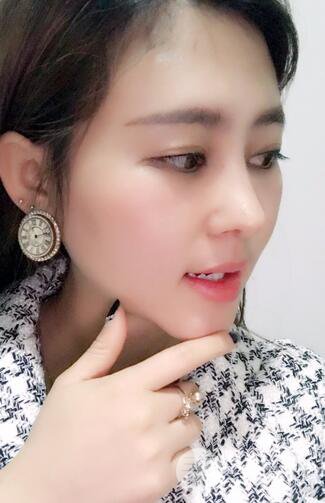 膨体隆鼻术后恢复果图_全过程解密