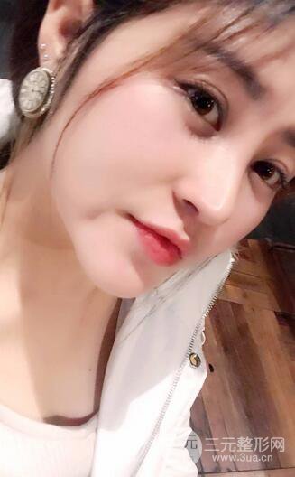 膨体隆鼻术后恢复果图_全过程解密