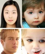 什么是生物焊接双眼皮手术?