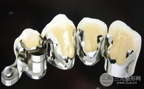 钛合金烤瓷牙好吗、价格怎么样