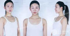 妙桃假体丰胸价格|隆胸果术后图片展示
