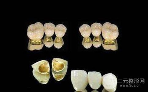 黄金烤瓷牙的使用寿命是多久、黄金烤瓷牙价格