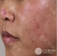 去除手术疤痕的有方法缓解果图片分享