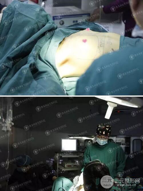 隆胸手术成功图片图片