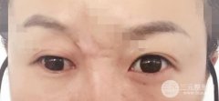 注射微j瓷隆鼻多少钱？有什么后遗症？