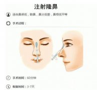 注射隆鼻种类有哪些?注射隆鼻材料介绍! 注射隆鼻种类有哪些?注射隆鼻材料介绍!