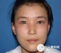 长沙激光祛斑哪家医院好？价格多少钱？