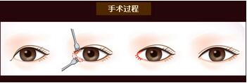 开眼角有危险吗？开内外眼角的方式解说~